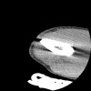 SPORK, NICO - 22.03.1976 - 02.08.2022 - CT obere Extremität - 17:51:17